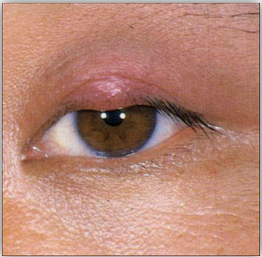 肿起结节如麦粒,红肿较轻者,称为针眼;胞睑漫肿,红肿较重者,称为眼丹