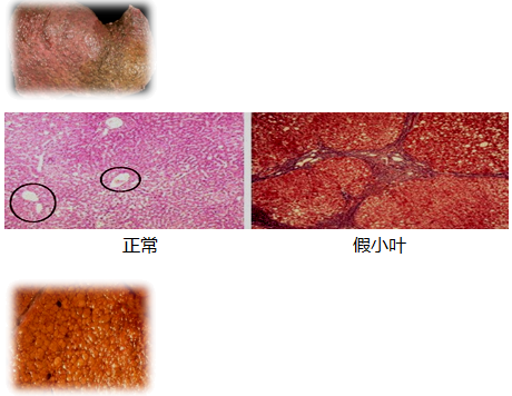肝硬化假小叶图片对比图片
