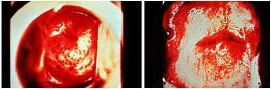 严重者有散在出血斑点,甚至宫颈有出血点,形成 "草莓样"宫颈,后穹隆有