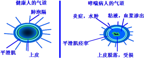 哮喘的本質——氣道炎症 平滑肌痙攣其他機制:病毒感染,心理,遺傳神經