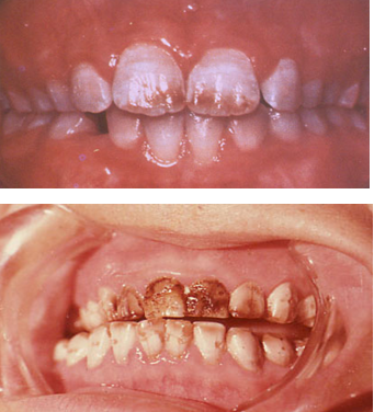 在牙發育礦化時期機體攝入過量的氟所引起的一種特殊的釉質發育不全