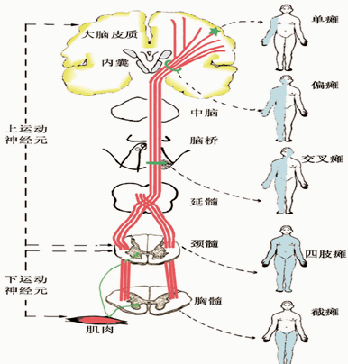 交叉性瘫痪 m.med66.com