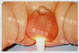 鞘膜积液透光试验阳性.2.睾丸下降不全,注意阴囊内有无睾丸.